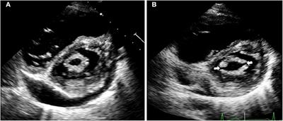 Decreased Cytokine Plasma Levels and Changes in T-Cell Activation Are Associated With Hemodynamic Improvement and Clinical Outcomes After Percutaneous Mitral Commissurotomy in Patients With Rheumatic Mitral Stenosis